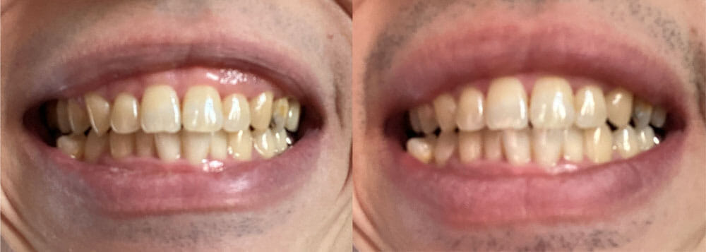 【フィリップス 電動歯ブラシ ソニッケアーレビュー】安価な電動歯ブラシ「イージークリーン」でホワイトニング効果は十分｜上位機種との比較や使い方も解説｜【効果検証】２週間チャレンジ